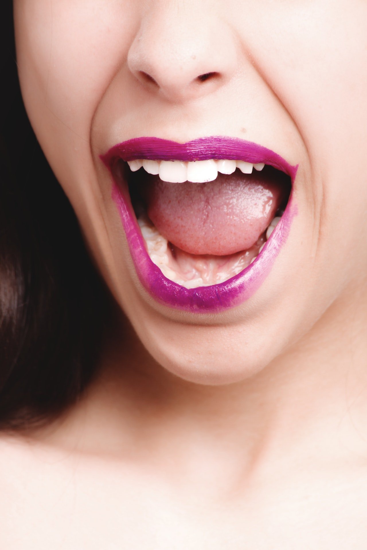 Yakın plan güzel bir kadın ağzı. Daha önce periodontal cerrahi görmüş. Şimdi iyileşmiş. Gülümsüyor.